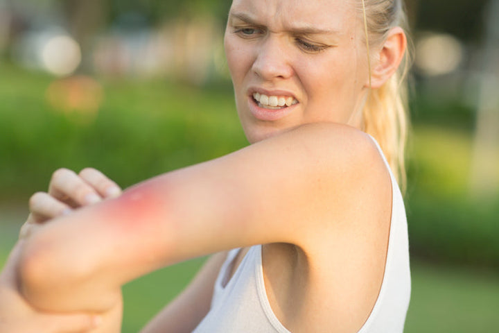 Don’t Let Bugs and Bites Ruin Your Australian Summer Holidays