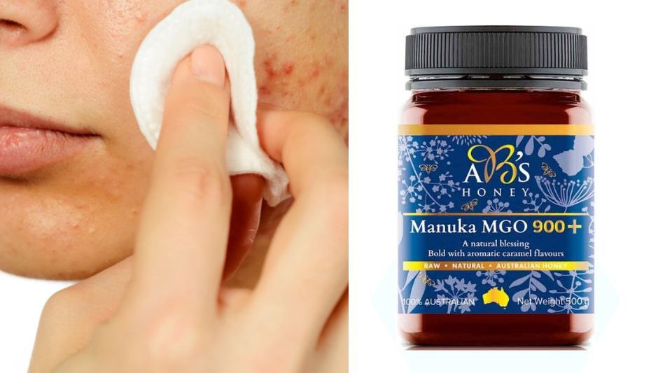 Manuka Honey as an acne treatment