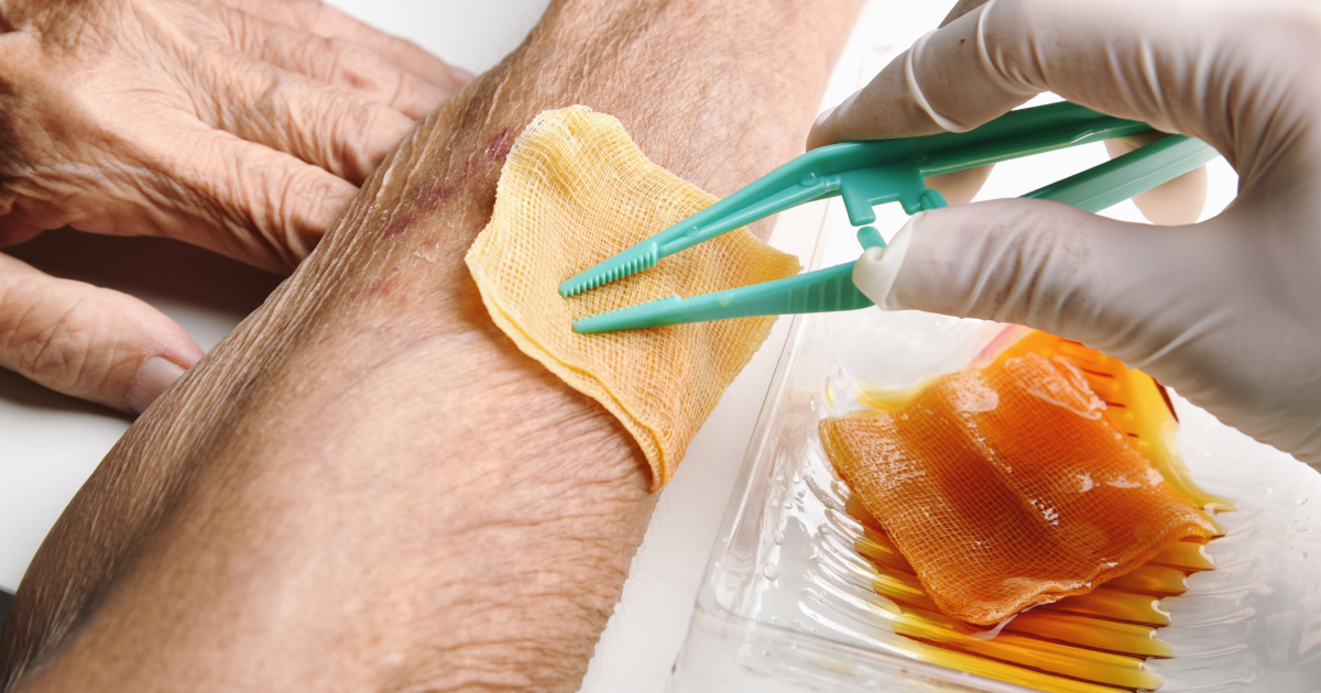 Dressing soaked in honey being applied to a wound